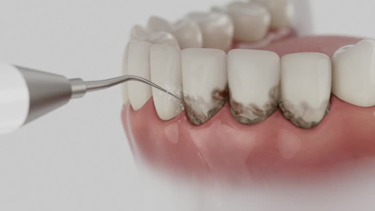Reliable Dental Implants contractor in Drexel, OH by Smile Center Dentistry